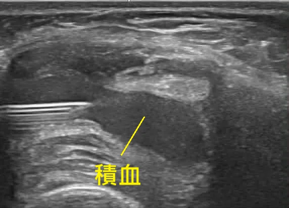 膝關節超音波顯示關節積血