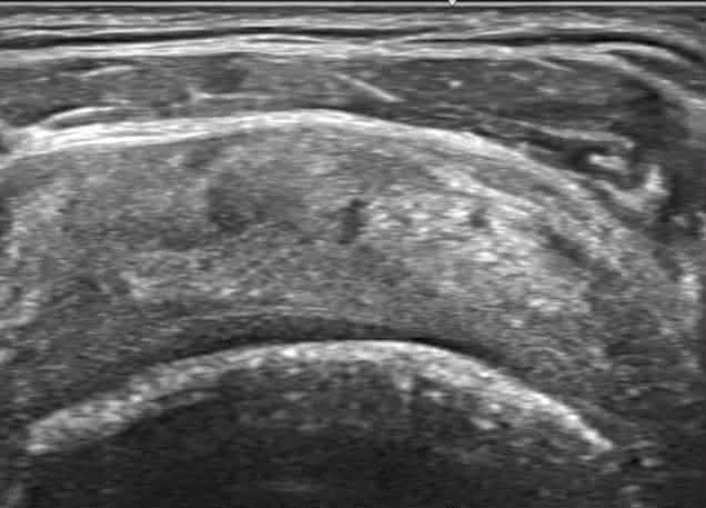 林羿辰醫師旋轉肌撕裂案例：治療後