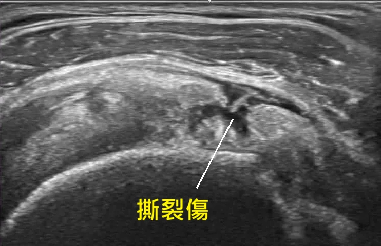 林羿辰醫師旋轉肌撕裂案例：治療前