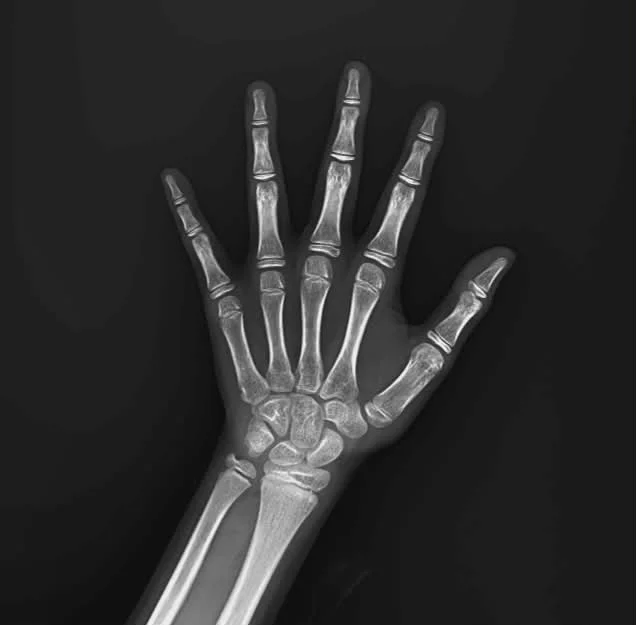 新竹宸新復健科臨床成功案例:妳敢信這是一雙7歲的手?全班最高的她,骨齡竟已10歲...偷走身高的性早熟警訊