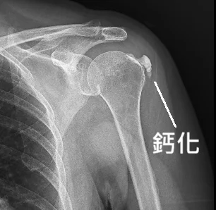 新竹宸新復健科臨床成功案例:誤把「結石」當「撕裂傷」?健身美女打了三次PRP無效,原來肩膀藏了顆大石頭!