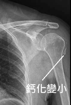 林羿辰醫師鈣化性肌腱炎案例：治療後