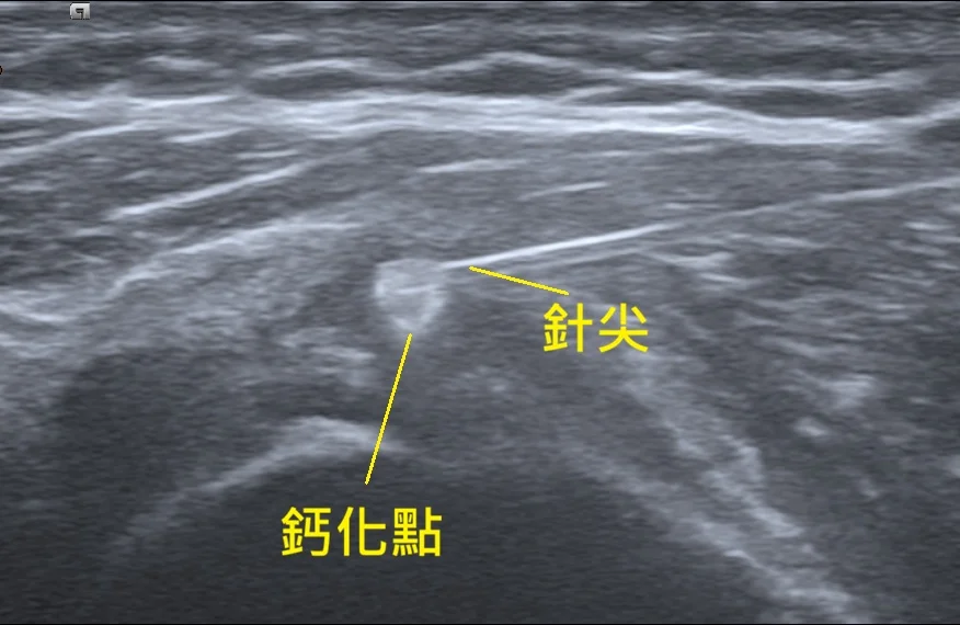 鈣化沖洗超音波圖
