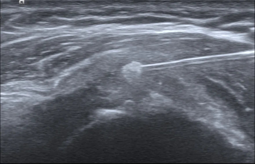 鈣化沖洗超音波圖