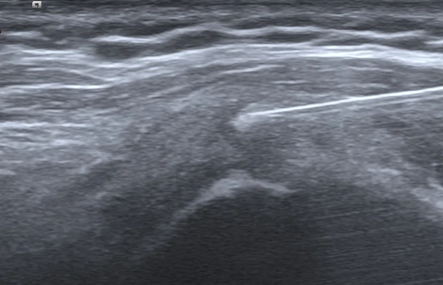 鈣化沖洗超音波圖