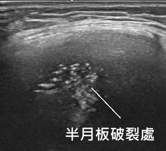 超音波導引下精準注射半月板破裂處