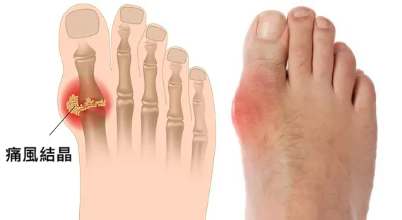 痛風發作紅腫熱痛