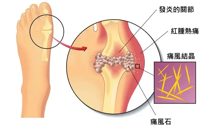 尿酸結晶沈積示意圖