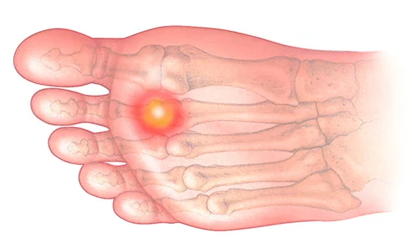 蹠趾關節炎或滑囊炎