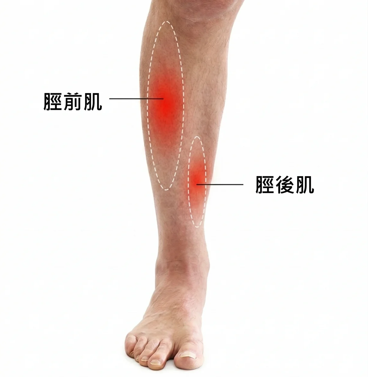 夾脛痛疼痛位置示意圖