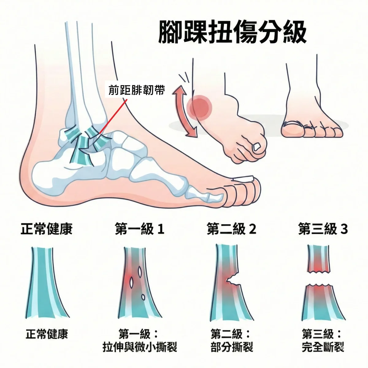 腳踝外側韌帶(前距腓韌帶)撕裂傷示意圖