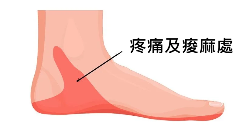 跗骨隧道症候群疼痛處