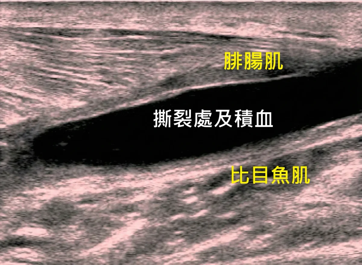 網球腿超音波圖片