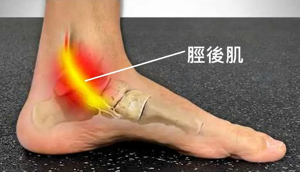 脛後肌腱炎