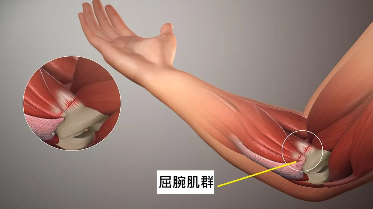 高爾夫球解剖結構示意圖,標示內側疼痛點