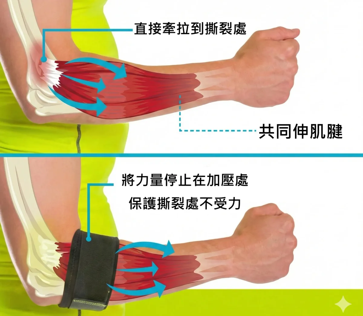 網球肘護具機轉