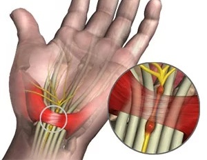 腕隧道症候群原理與構造