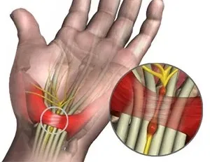腕隧道症候群原理與構造