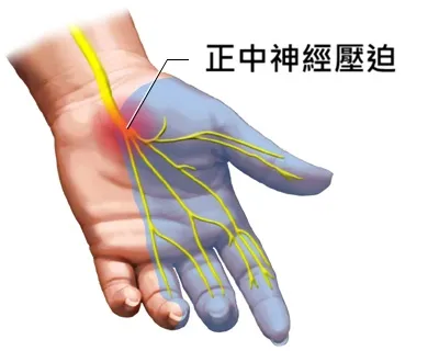 腕隧道症候群症狀