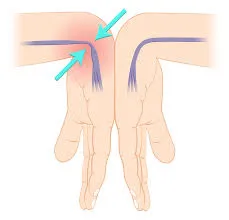 腕隧道症候法倫氏測試 (Phalen's test) 動作示範