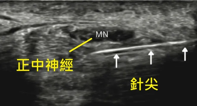 腕隧道症候群超音波導引神經解套術注射