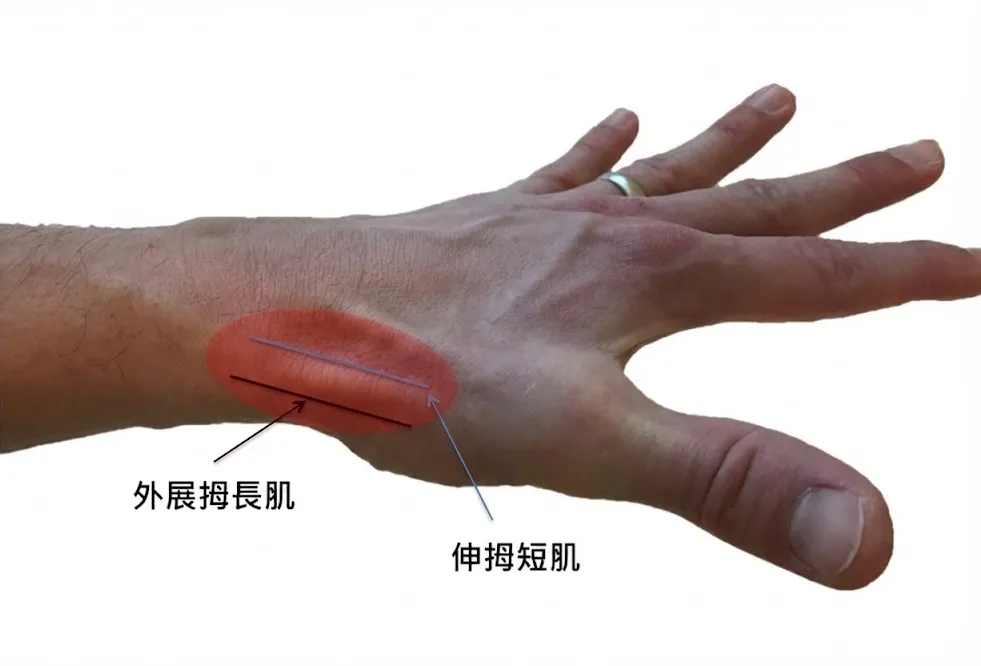 媽媽手肌肉構造