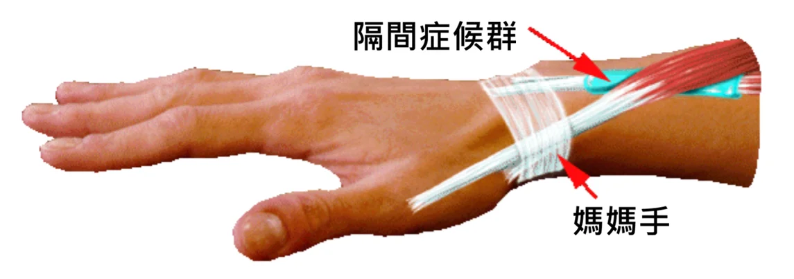 隔間症候群與媽媽手比較