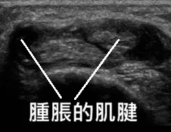 隔間症候群超音波圖片