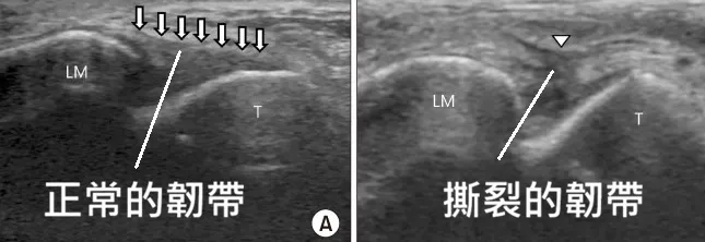 舟月韌帶超音波影像
