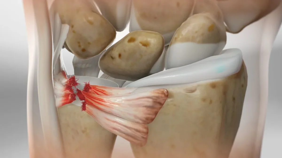 三角纖維軟骨損傷結構