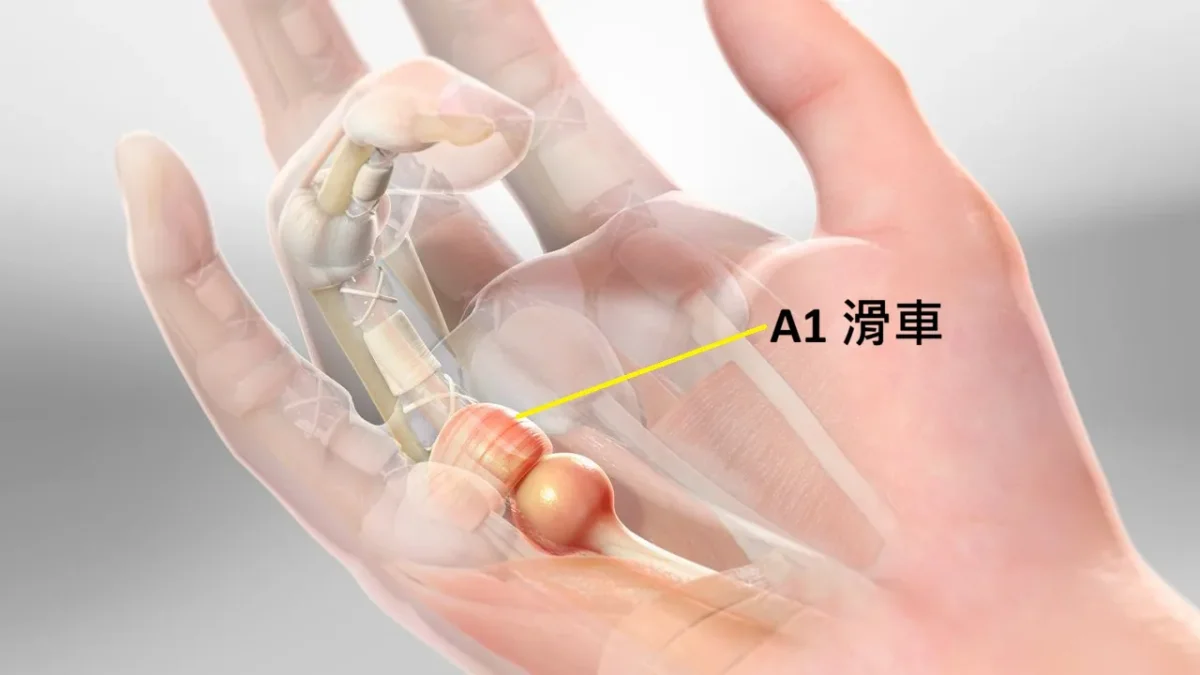 板機指構造示意圖