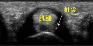 板機指超音波導引注射