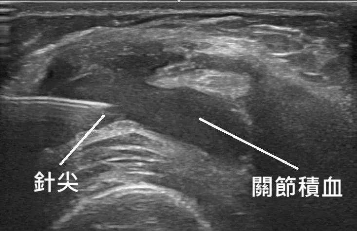膝關節超音波導引抽血