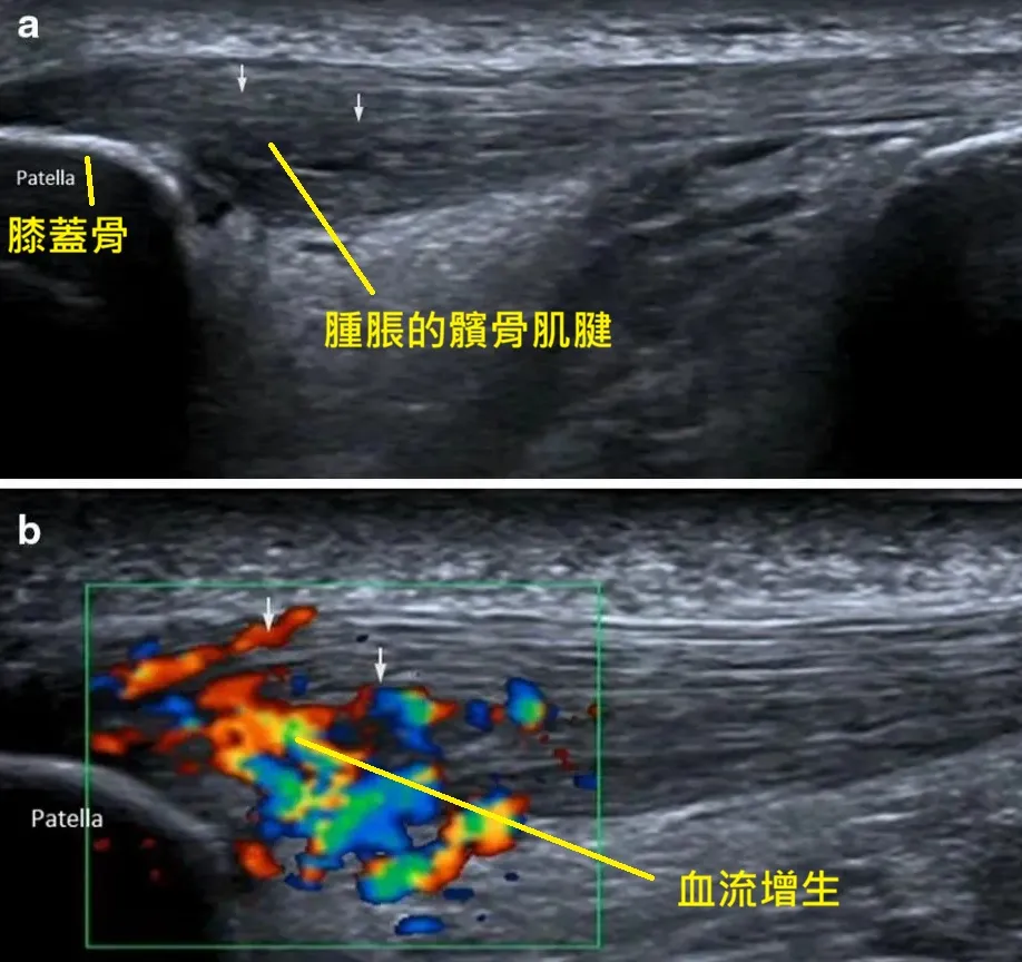 髕骨肌超音波影像