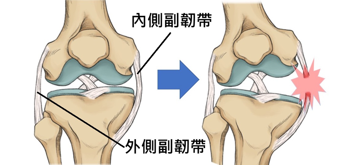 內側副韌帶受傷結構