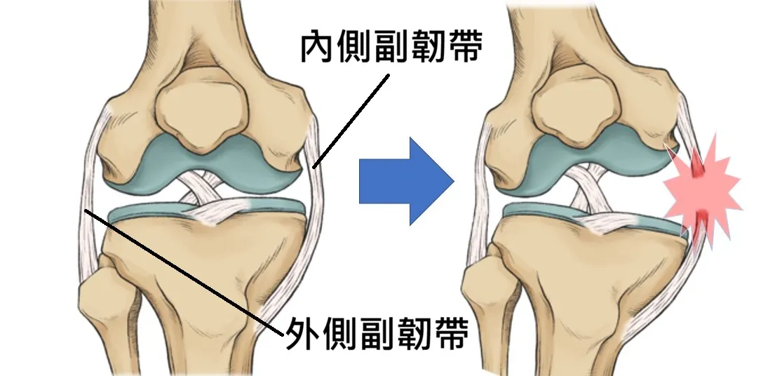 內側副韌帶受傷結構