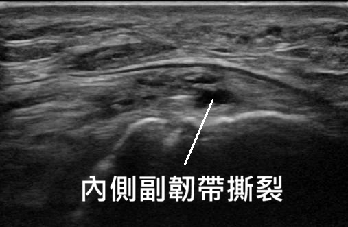 內側副韌帶受傷超音波圖片