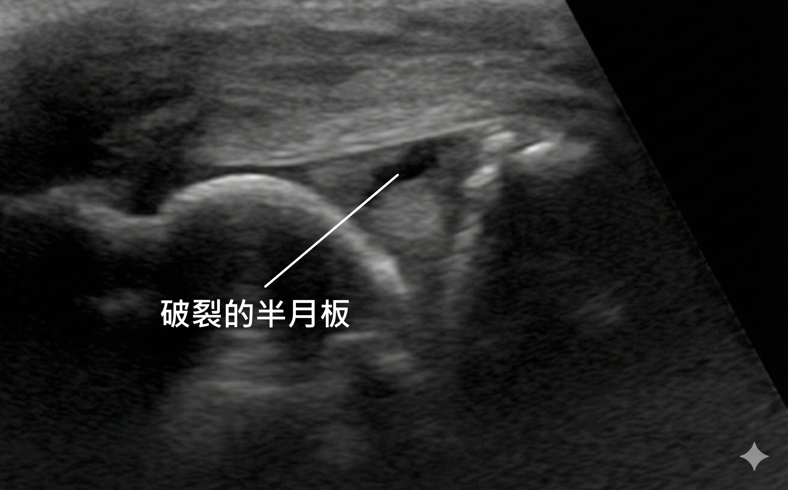 半月板受傷的超音波影像