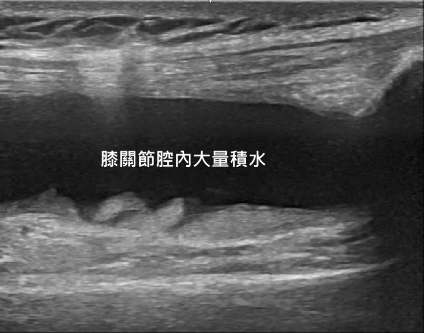 退化性關節炎膝蓋積水