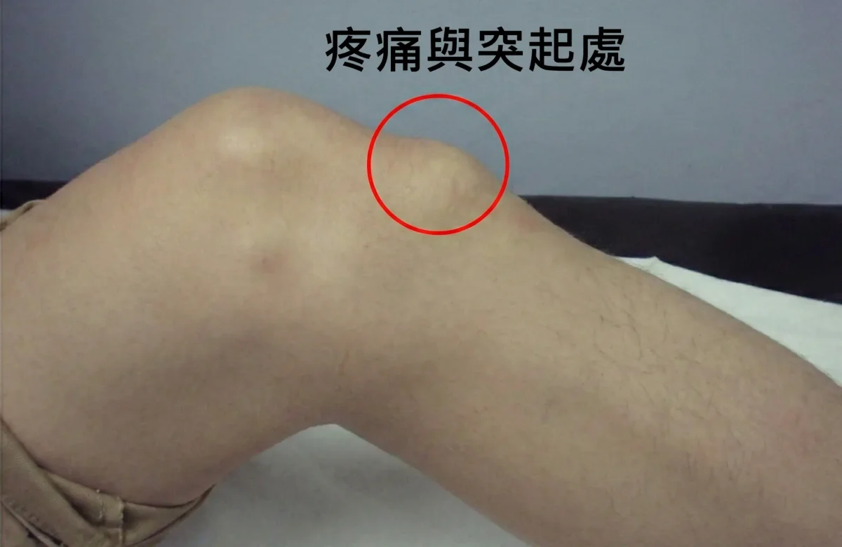 奧斯戈德氏病痛點位置