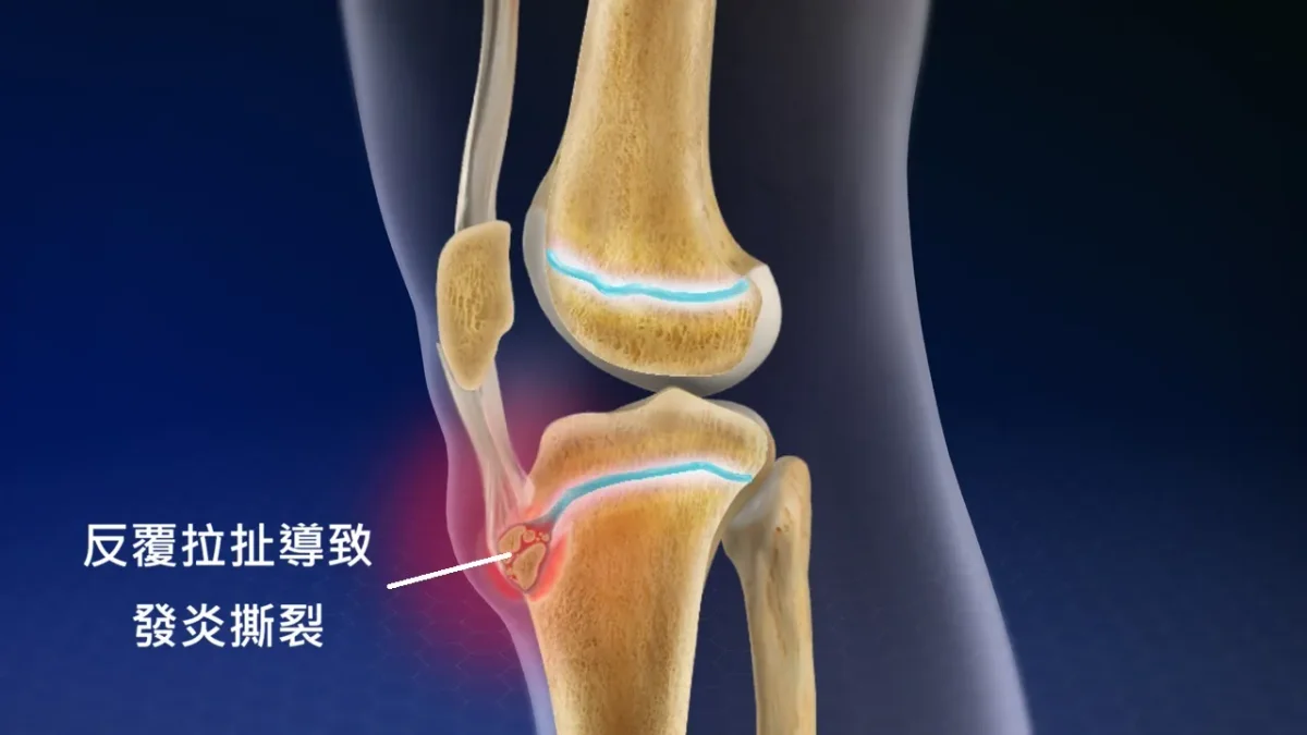 脛骨粗隆拉扯示意圖