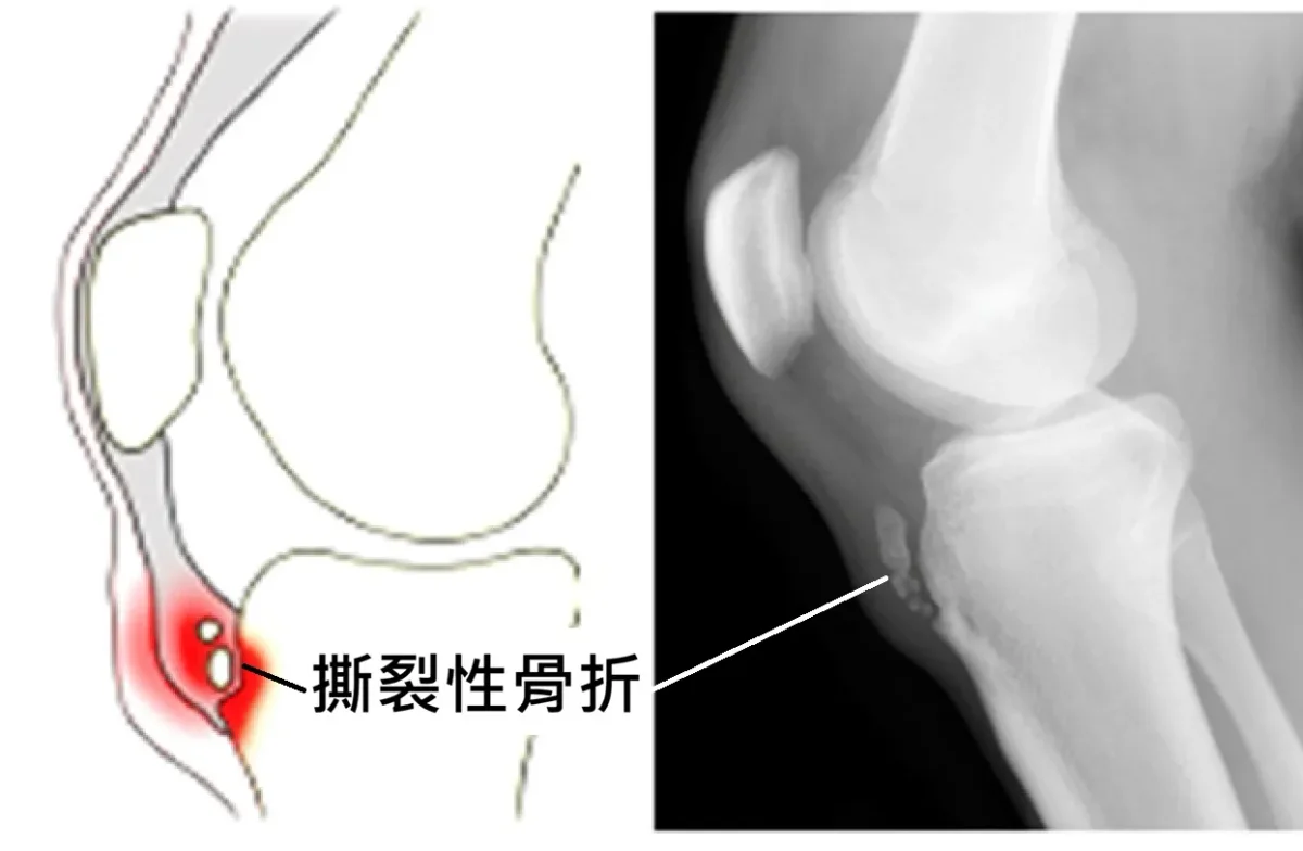 奧斯戈德氏病撕裂性骨折