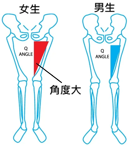 髕骨軟化症因Q角 (Q-Angle) 過大