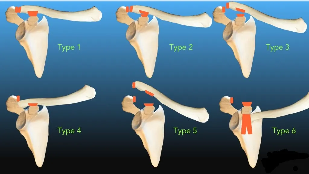 肩鎖關節受傷分級