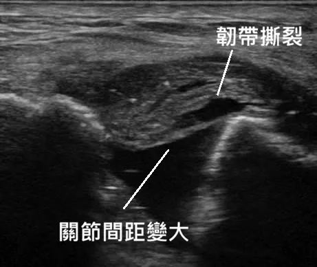 肩鎖關節受傷超音波影像