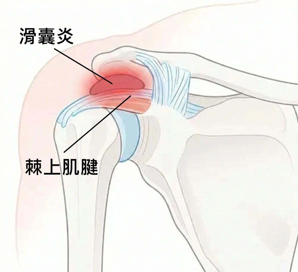 旋轉肌建炎與滑囊炎