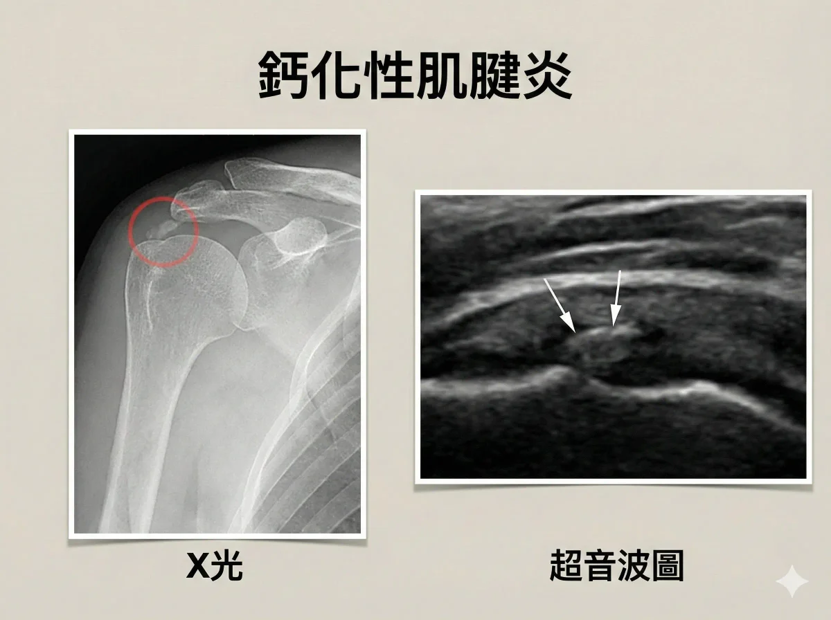 旋轉肌袖鈣化X光及超音波影像