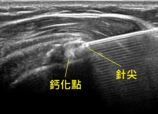 旋轉肌袖鈣化超音波導引抽吸術 (Barbotage)