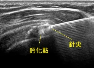 旋轉肌袖鈣化超音波導引抽吸術 (Barbotage)