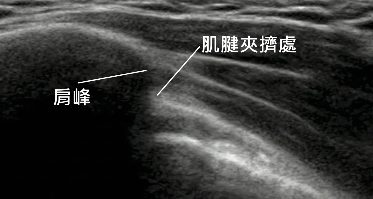 肩夾擠超音波影像